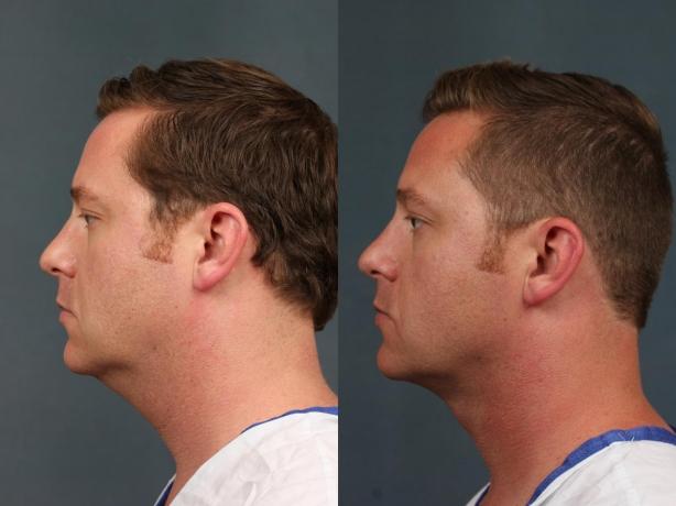 How Laser Neck Rejuvenation Change Your Appearance?